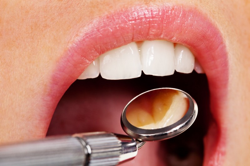 Sedation Dentistry