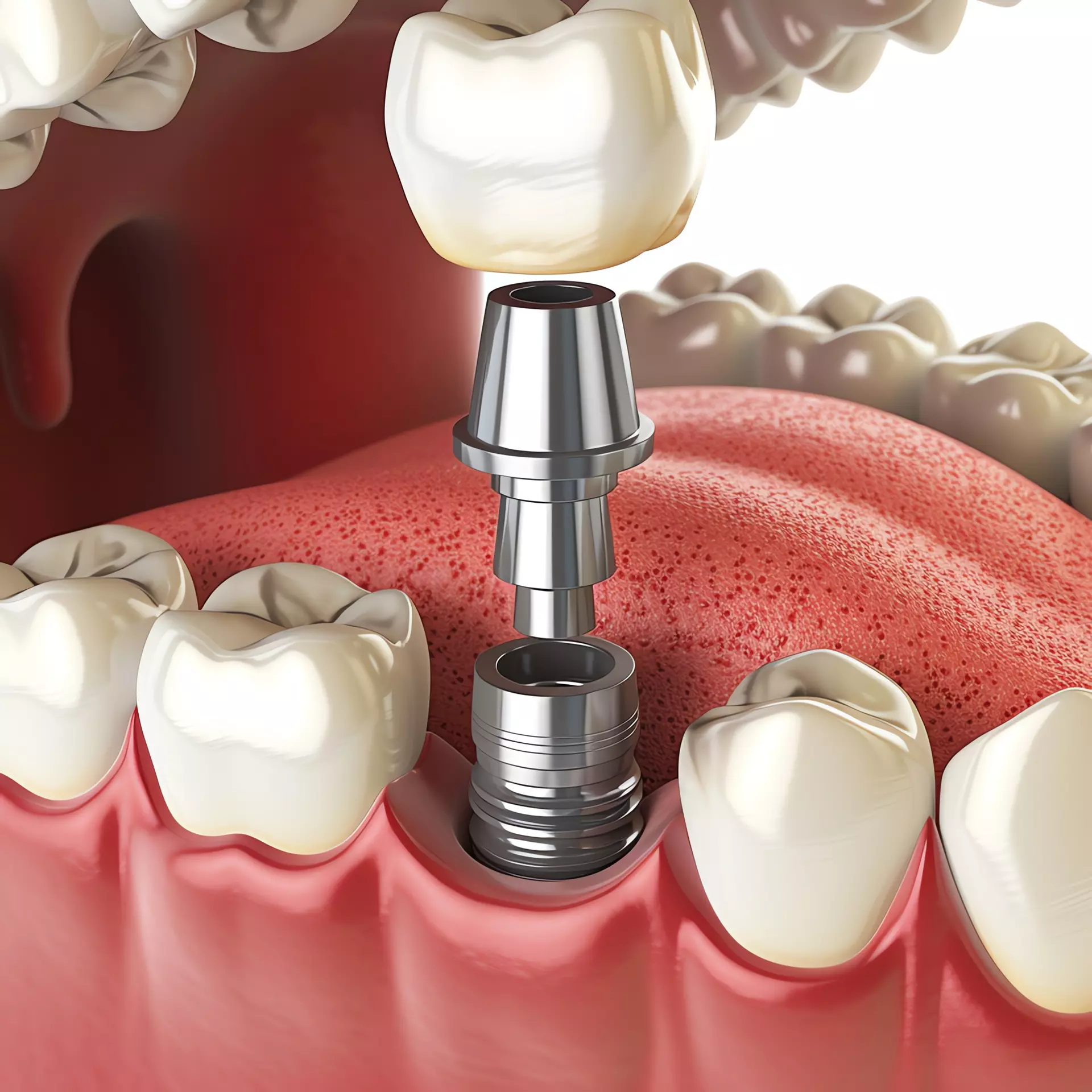 Implant Dentistry
